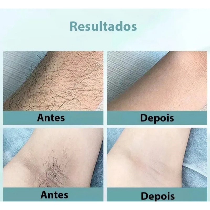 Depilador A Laser 900 Mil Pulsos Portátil Elimina Pelos Indolor Seguro e Eficaz